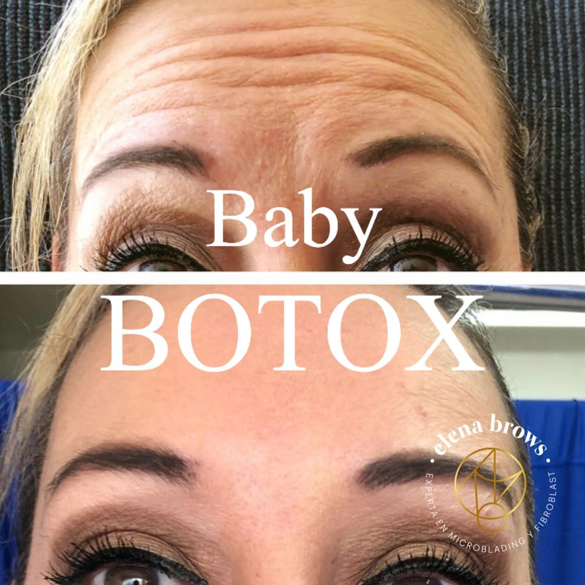 botox01