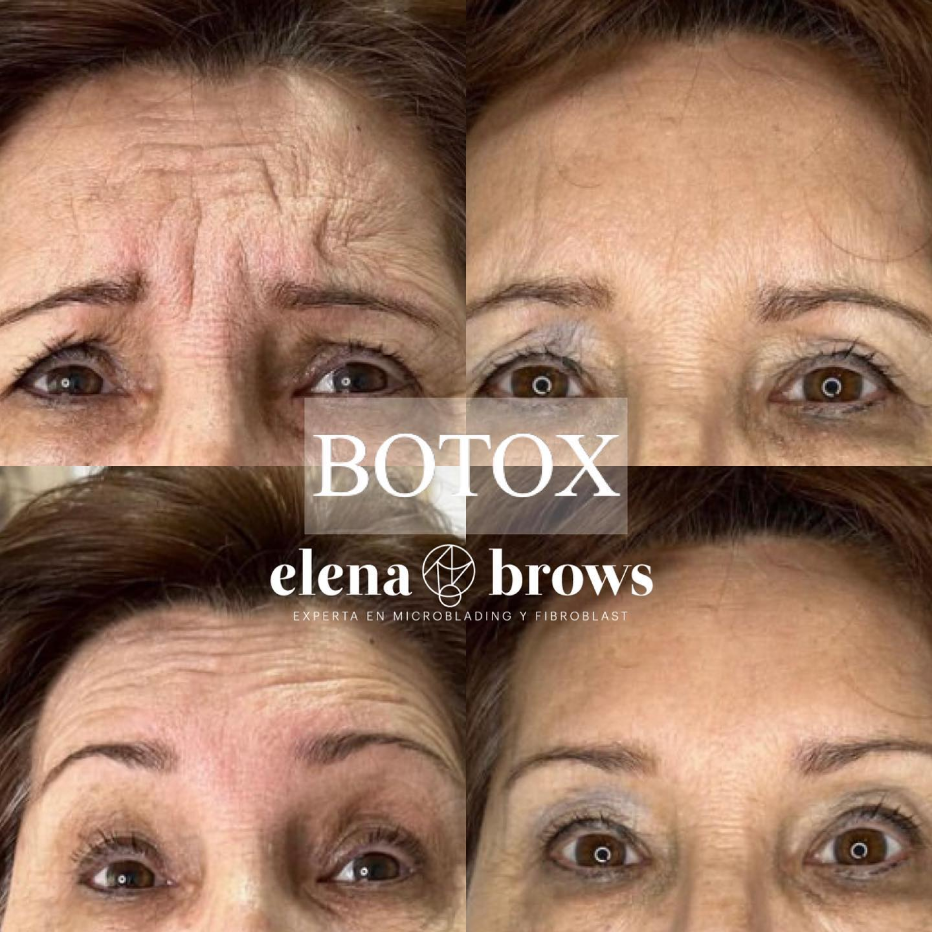 botox03